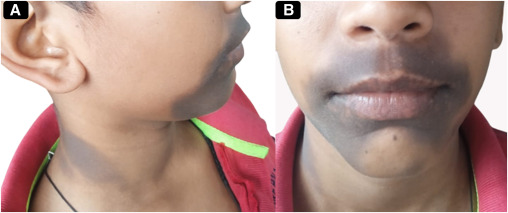 ترک ناس 4 عوارض مصرف شدید ناس و توصیه شدید به ترک ناس